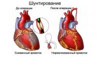 Что такое шунтирование сердца или реваскуляризация? Виды коронарного шунтирования сердца.. Экология и здоровье