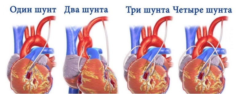 Что такое шунтирование сердца? Виды шунтирования сердца. | На ...