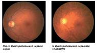 Что такое глаукома? Методы ее лечения.. Экология и здоровье
