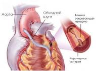Что такое шунтирование сердца или реваскуляризация? Виды коронарного шунтирования сердца.. Экология и здоровье