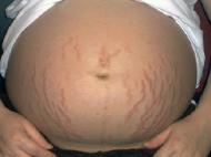 Как избежать растяжек во время беременности?. Семья и дети, Экология и здоровье